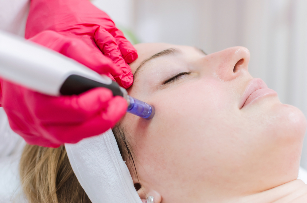 microneedling