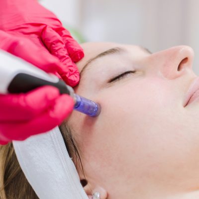 microneedling